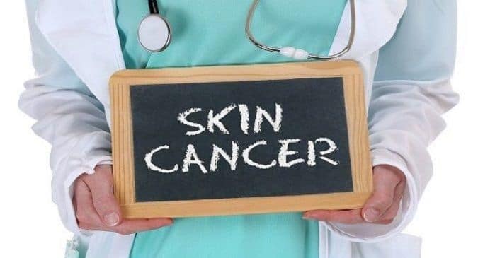 skin cancer - death of partner can increase risk | TheHealthSite.com