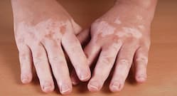 Know-How Homeopathy Focuses On The Physical Aspects Of Vitiligo