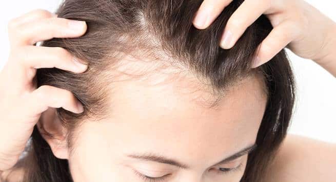 बल क झडन परकर करण उपचर Hair Loss Types Causes Treatment in  Hindi