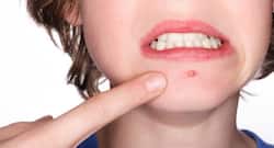 पान के पत्ते हैं गर्मियों में होने वाली फुसी-फोड़े का नैचुरल इलाज।