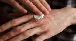 Psoriasis can be a cosmetic nightmare, but you can easily overcome this