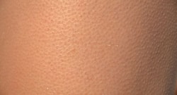 Don’t want to go for chemical peel to treat strawberry legs? Try these home remedies