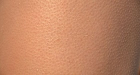Don’t want to go for chemical peel to treat strawberry legs? Try these home remedies