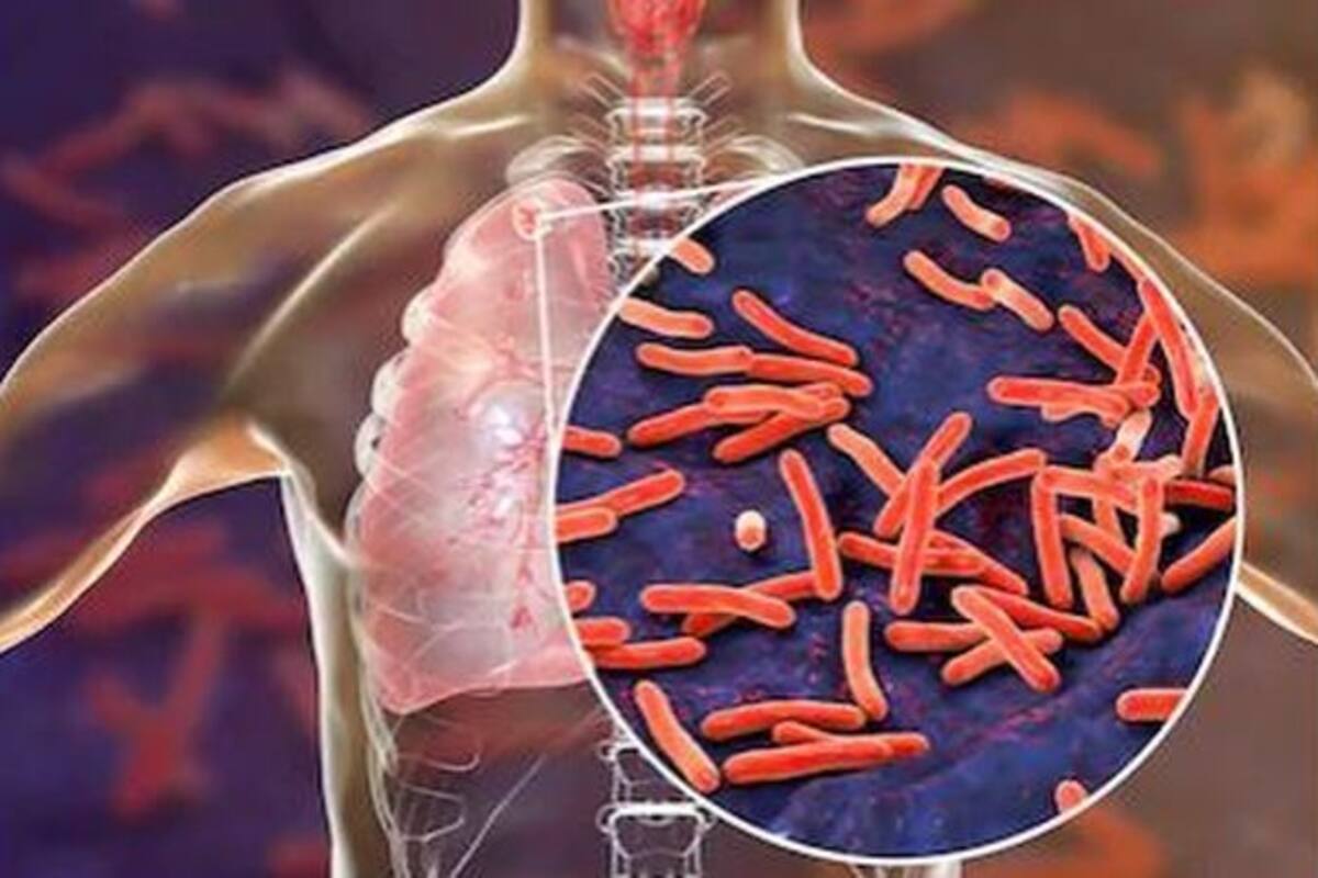 World Tuberculosis Day Will Tb Increase Your Risk Of Coronavirus
