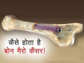 Bone Marrow Cancer warning signs in hindi :  हड्डियों में होने लगे दुखन तो शरीर कर रहा है इस कैंसर का इशारा, जानें शरीर में दिखाई देने वाले आम बदलाव