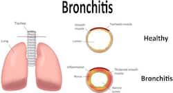 Bronchitis in the times of COVID-19 can be a pain: Deal with it naturally