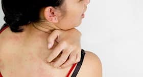 5 simple home remedies to deal with prickly heat