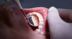 Worried about receding gums? Try our effective home remedies