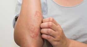 5 simple and effective home remedies for skin allergies