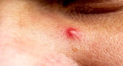 Beauty tips for men: 5 natural and inexpensive ways to battle acne problem during summer