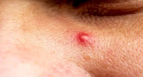 Beauty tips for men: 5 natural and inexpensive ways to battle acne problem during summer