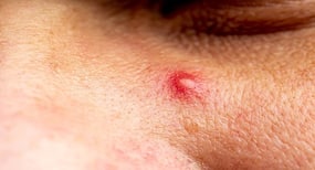 Beauty tips for men: 5 natural and inexpensive ways to battle acne problem during summer
