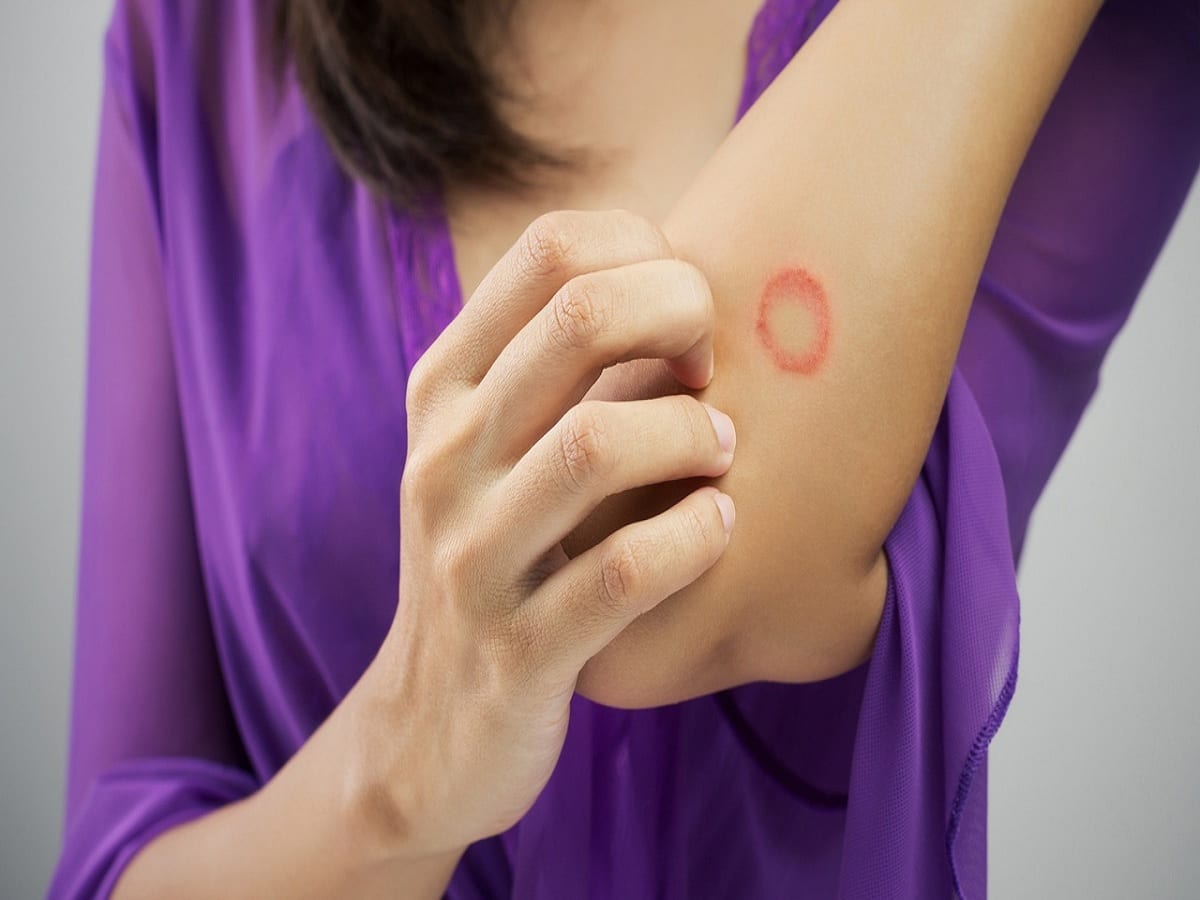Fungal infections of the skin: symptoms, causes, and treatment - MyHealth