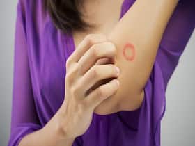 Troubled By Ringworm? 5 Natural Remedies To Cure The Common Fungal Infection