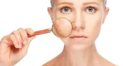 Home Remedies For Pigmentation : चेहरे पर झाइयां होने के कारण और घरेलू उपाय