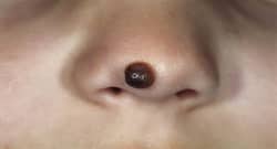 Apple cider vinegar and other home remedies for moles