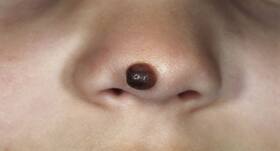 Apple cider vinegar and other home remedies for moles