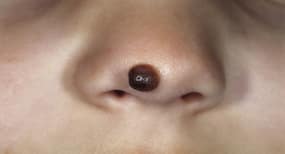 Apple cider vinegar and other home remedies for moles