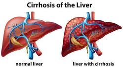 Women less likely to die of liver cirrhosis than men: Know the symptoms of this disease