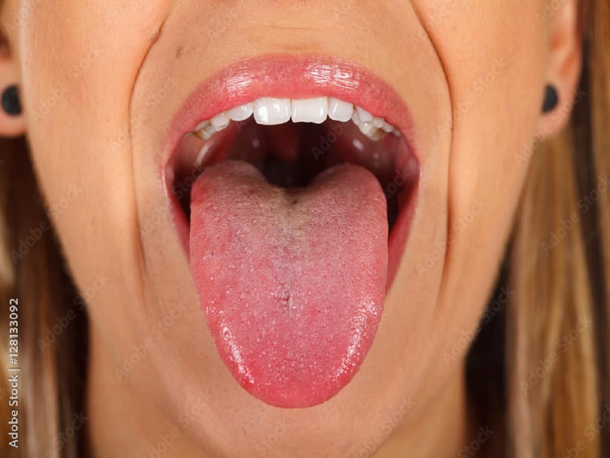 stress bumps on tongue