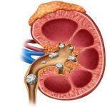 kidney-stones