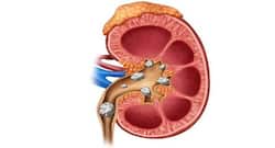 Diabetes And Kidney Stones: Understanding The Link And Reducing Risk