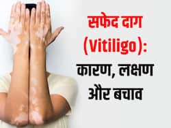 क्या छूने से फैलती है सफेद दाग की समस्या? जानें कारण, लक्षण और बचाव के तरीके