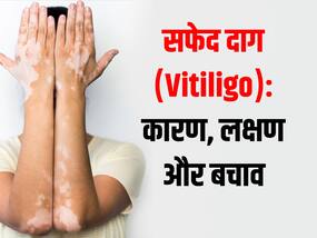 क्या छूने से फैलती है सफेद दाग की समस्या? जानें कारण, लक्षण और बचाव के तरीके