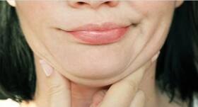 Chew gums and pout often to get rid of double chin Chew gums and pout often to get rid of double chin