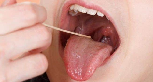 mouth infection