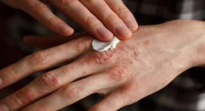 skin diseases early stage eczema psoriasis