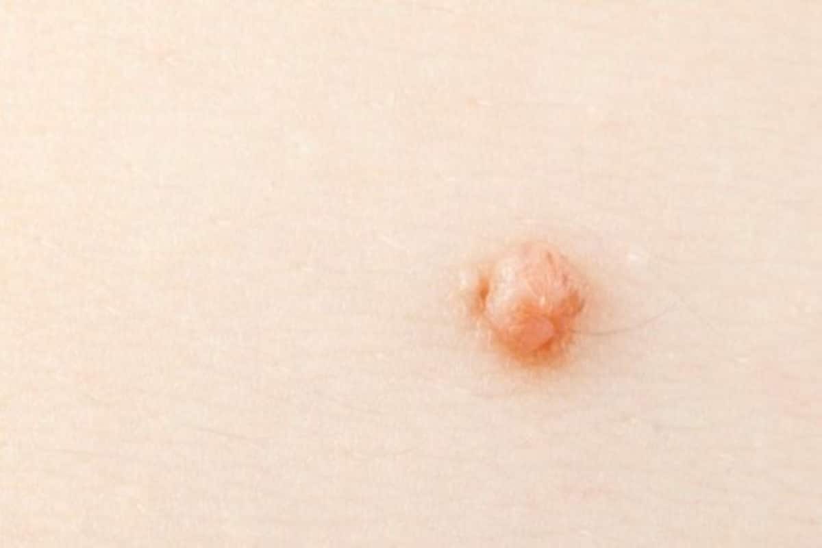 Hpv warts number