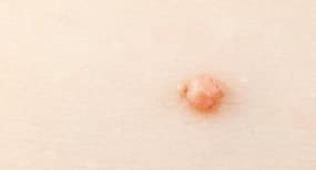 Get Rid Of Your Genital Warts With These Effective Home Remedies But Consult A Doctor First