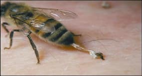 Breakthrough discovery: Honeybee venom could help treat triple-negative breast cancer