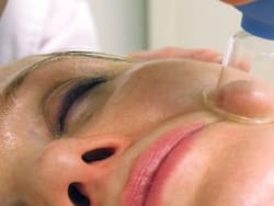 Facial cupping can give you an instant facelift and more