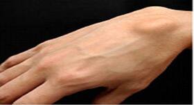 Home remedies to get rid of lipomas, that benign lump just under your skin Home remedies to get rid of lipomas, that benign lump just under your skin