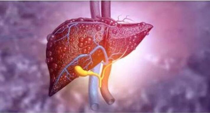 Liver Cancer Symptoms Causes Diagnosis And Treatment Liver Cancer Symptoms Causes Diagnosis And Treatment