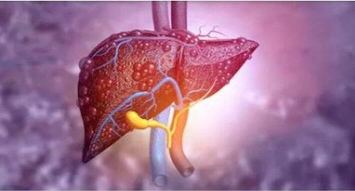 Liver Cancer Symptoms Causes Diagnosis And Treatment