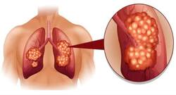 World Lung Cancer Day 2020: Types and symptoms of lung cancer