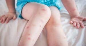 insect bite