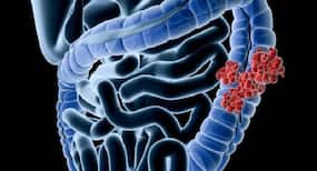 Eating dairy products may cut bowel cancer risk: Fruits, veggies help too