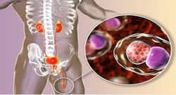 युरेथराइटिस क्या है? युरेथराइटिस के लक्षण, कारण, इलाज