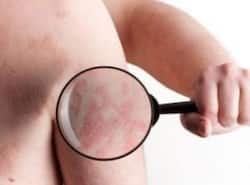 Psoriasis: Why early diagnosis and medication is important