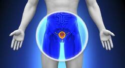 Benign Prostatic Hyperplasia: Can Early Detection Lead To Treatment?