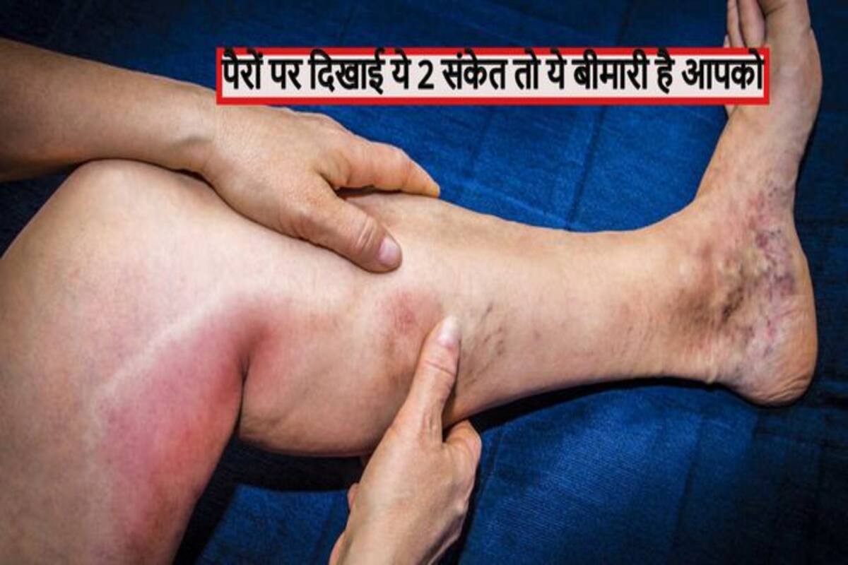 प र म द ख ई द य 2 स क त त ज न ल नस म बनन लग ह ख न क थक क ज न क स ब म र क श क र ह न व ल ह आप Thehealthsite Com ह द