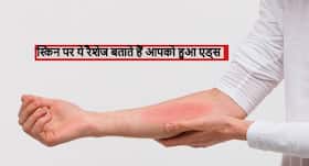 AIDS होने पर स्किन में तुंरत आ जाते हैं ये 4 बदलाव, समय रहते पहचानें इन्हें AIDS होने पर स्किन में तुंरत आ जाते हैं ये 4 बदलाव, समय रहते पहचानें इन्हें