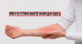 AIDS होने पर स्किन में तुंरत आ जाते हैं ये 4 बदलाव, समय रहते पहचानें इन्हें