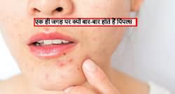 पिंपल्स एक ही जगह पर क्यों होते हैं? जानें कारण और बदलें अपनी ये 5 आदतें, नहीं होंगे पिंपल्स