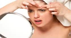 एक्ने कम करने के अचूक घरेलू उपाय, मुहांसों से छुटकारा पाने के नैचुरल तरीके ।