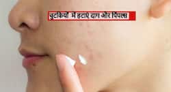 चेहरे पर दाग, झाईयों और पिंपल को जल्द से जल्द खत्म कर देंगे ये 7 अचूक उपाय, बिना पैसे के चमक जाएगी आपकी स्किन